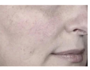 Помощь при куперозе, розацеи